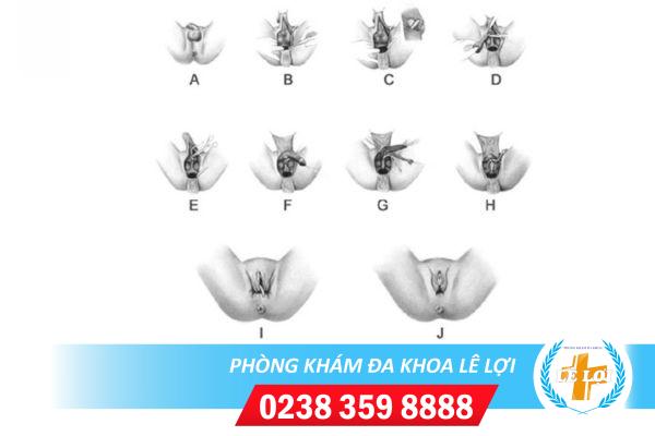 Chỉnh hình bộ phận sinh dục ở nữ giới