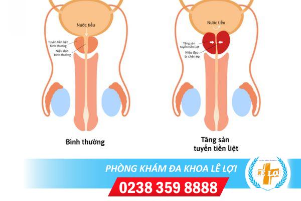 Tăng sản tuyến tiền liệt ở nam giới