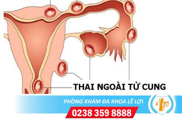 Dấu hiệu nhận biết có thai ngoài tử cung