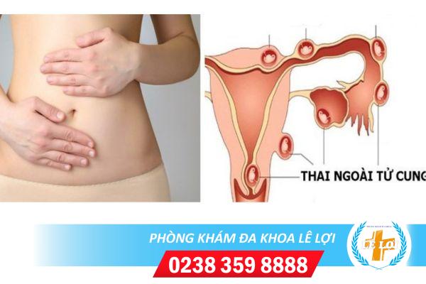 Dấu hiệu chửa ngoài tử cung chị em nên biết