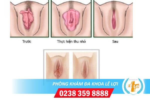 Thu hẹp âm đạo có đắt không ?