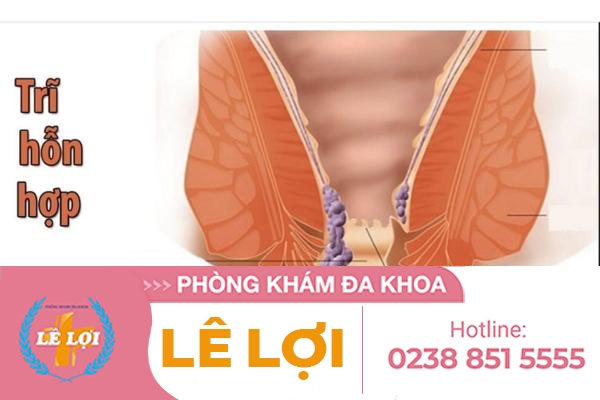 Dấu hiệu và cách điều bệnh trị trĩ hỗn hợp hiệu quả