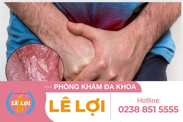 Tróc da quy đầu là bị bệnh gì?