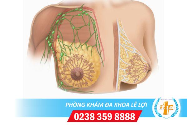 U tuyến vú ảnh hưởng đến sức khỏe như thế nào ?