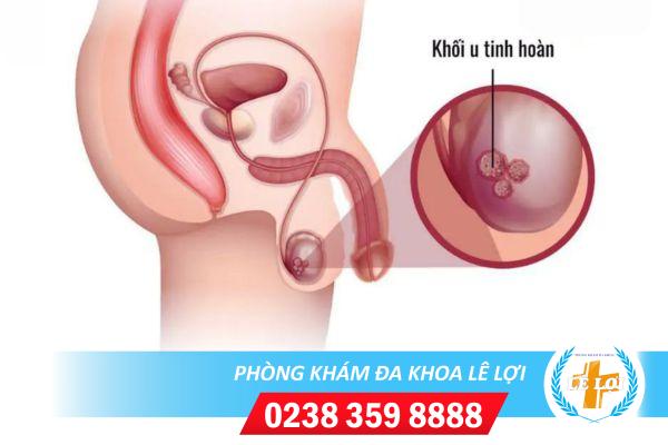 Nguyên nhân dẫn tới u tinh hoàn