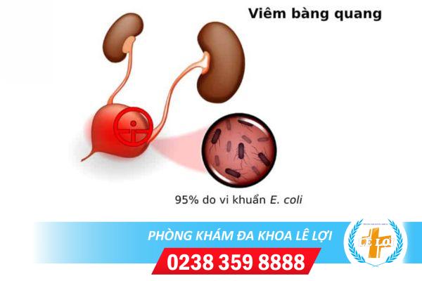 Triệu chứng của bệnh viêm bàng quang