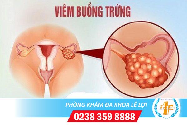 Vô sinh buồng trứng ở nữ giới