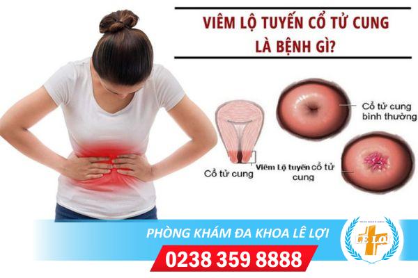 Điều trị viêm lộ tuyến cổ tử cung – Phương pháp áp lạnh hay dao leep?