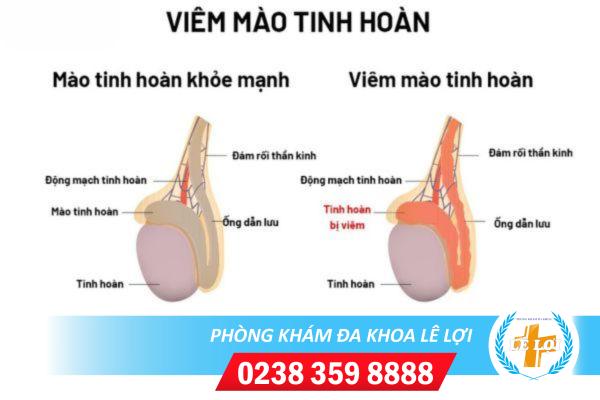 Tìm hiểu về bệnh viêm mào tinh hoàn