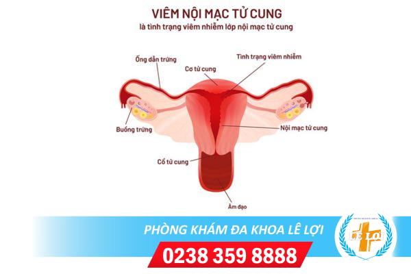 Viêm nội mạc tử cung là gì ? nguy hiểm không ?