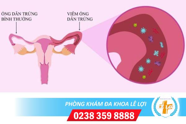 Viêm tắc ống dẫn trứng