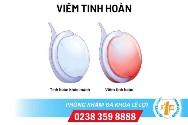 Dấu hiệu của bệnh viêm tinh hoàn ở nam giới