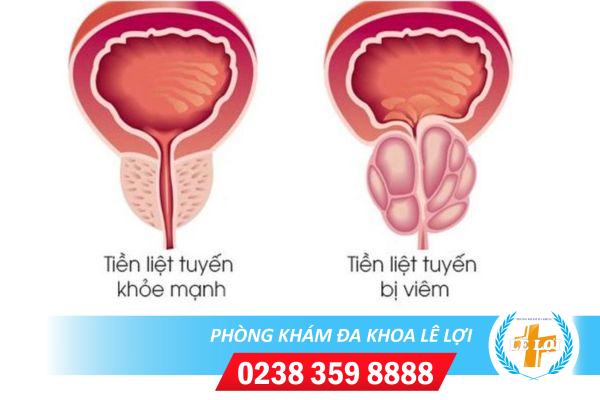 Viêm tiền liệt tuyến là bệnh gì ?