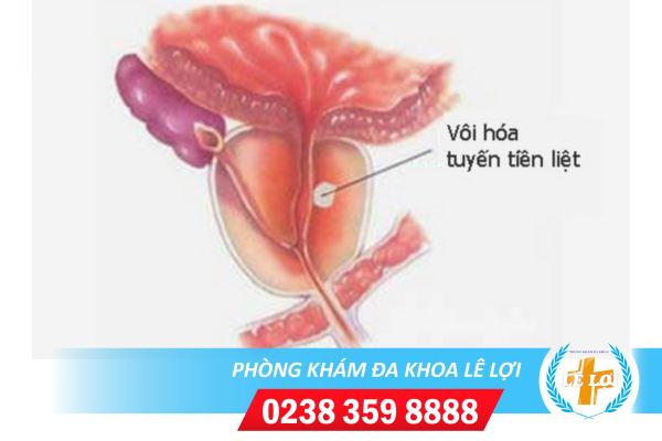 Hỗ trợ điều trị vôi hóa tuyến tiền liệt tại Đa Khoa Lê Lợi