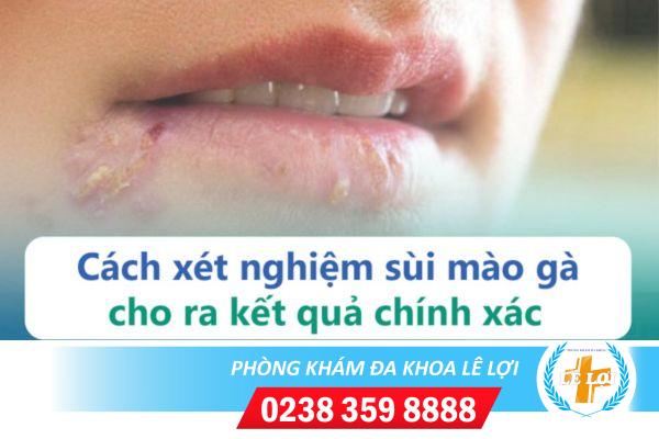 Cách xét nghiệm sùi mào gà hiệu quả hiện nay