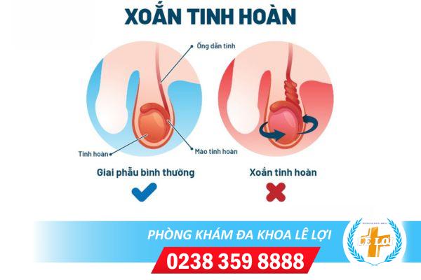 Xoắn tinh hoàn – triệu chứng bệnh nam khoa rất nguy hiểm