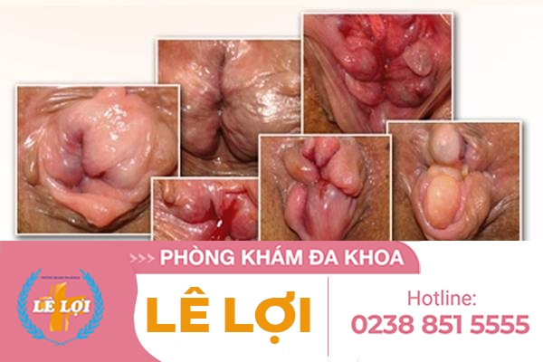 Benh-loi-dom-la-gi-nguyen-nhan-trieu-chung-va-cach-dieu-tri