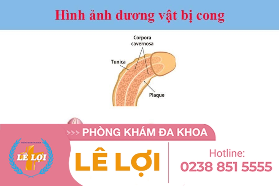 Cách khắc phục dương vật cong