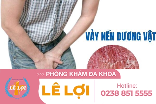 Hiện tượng vẩy nến ở dương vật