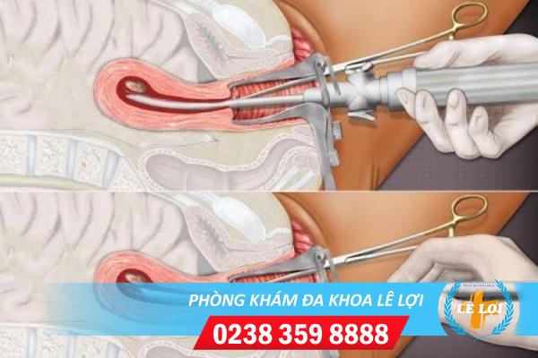 Quy trình nạo hút thai an toàn tại Phòng Khám Lê Lợi