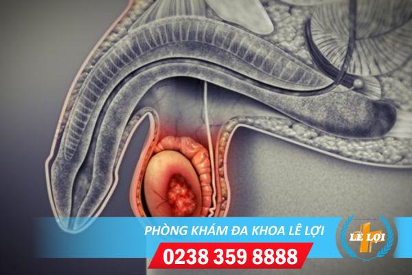 Dấu hiệu nhận biết ung thư tinh hoàn và cách điều trị hiệu quả