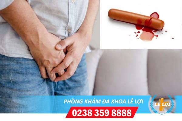 Chảy máu bao quy đầu là bị bệnh gì?