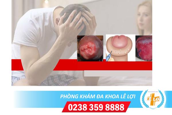 Nguyên nhân vì sao gây ra triệu chứng quy đầu bị sưng đỏ ?