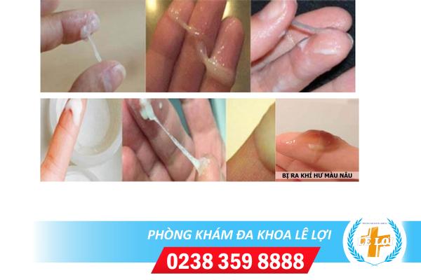 Bệnh huyết trắng nguy hiểm như thế nào?