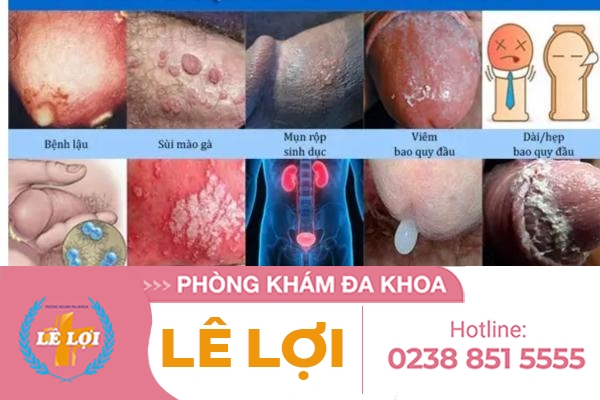 Nên hỗ trợ điều trị bệnh nam khoa ở đâu ?