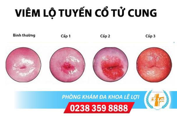 Sự nguy hiểm của căn bệnh Viêm Lộ Tuyến Cổ Tử Cung