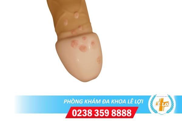 Da quy đầu nổi hột là bị bệnh gì?
