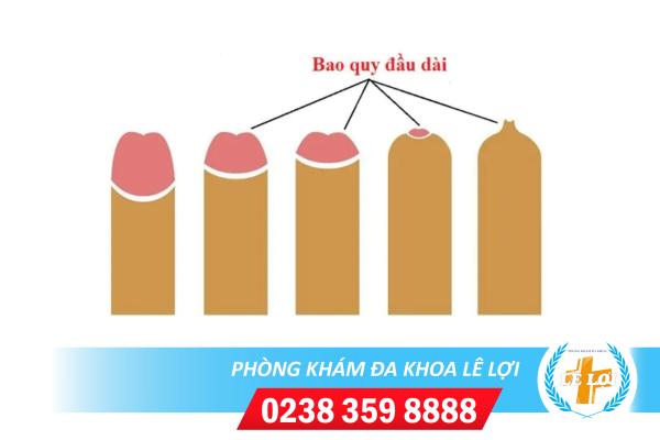 Bạn có biết dài bao quy đầu và nam giới có nên cắt bao quy đầu bị dài không?
