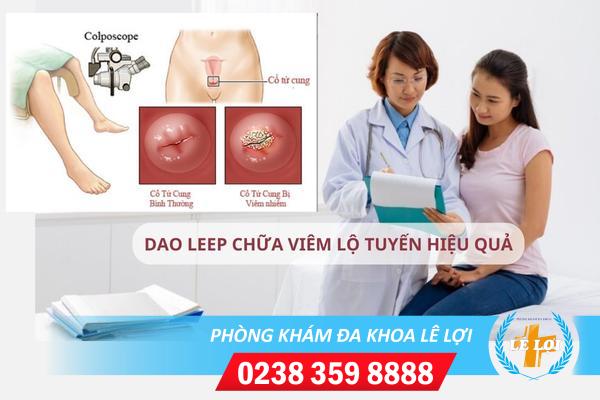 Hỗ trợ điều trị viêm lộ tuyến cổ tử cung với công nghệ Dao LEEP vượt trội