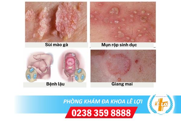 Bệnh hoa liễu là gì – Nguyên nhân, triệu chứng và cách hỗ trợ điều trị hiệu quả