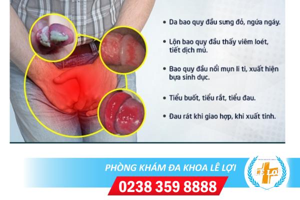 Những kiến thức bạn cần biết về bệnh viêm bao quy đầu