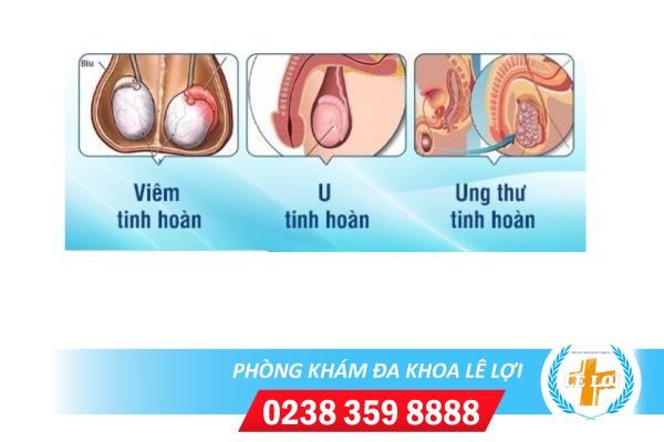 dau-tinh-hoan-nhung-khong-sung-do-benh-ly