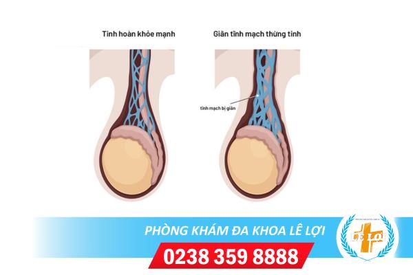 Hỗ trợ điều trị giãn mạch thừng tinh tại Đa Khoa Lê Lợi