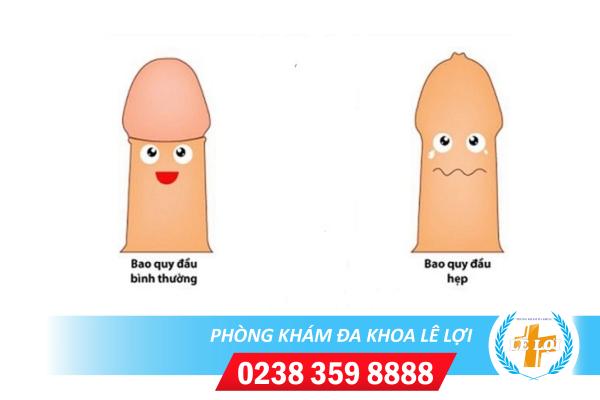 Những tác hại của dài bao quy đầu ở nam giới?
