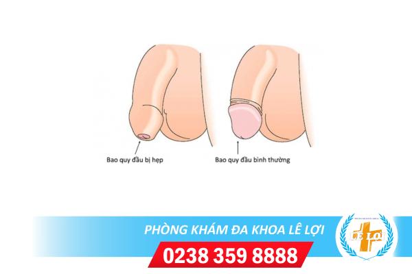Hẹp bao quy đầu là gì và có nên cắt bao quy đầu bị hẹp không?