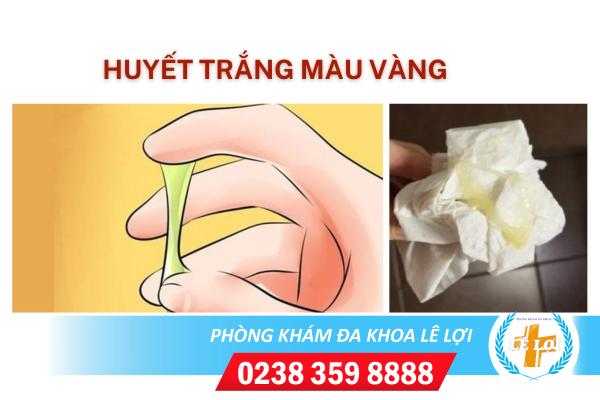 Huyết trắng màu vàng là bị bệnh gì?