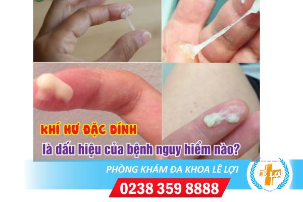 Bạn bị gì nếu ra khí hư đặc, cách hỗ trợ điều trị như thế nào?