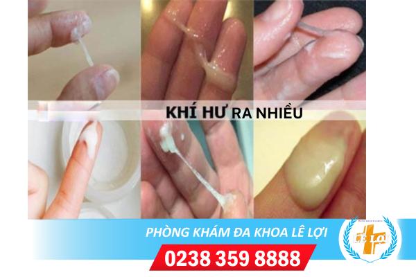 Hỗ trợ điều trị khí hư ra nhiều ở đâu tốt tại Nghệ An?