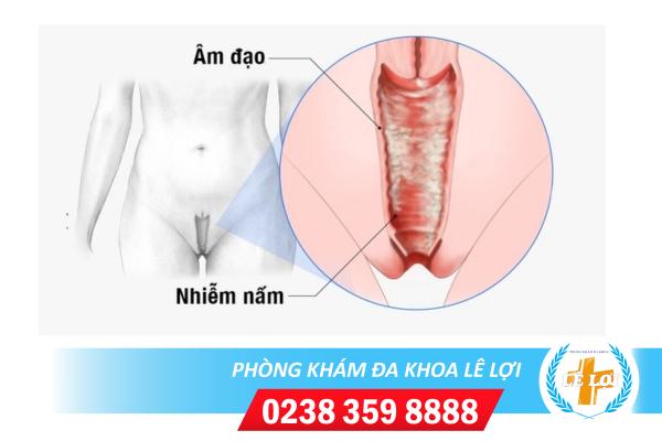 Phương pháp hỗ trợ điều trị nấm âm đạo như thế nào hiệu quả