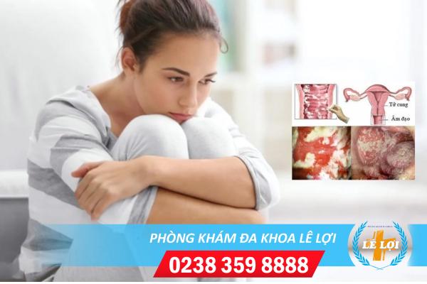 Nấm candida ở nữ giới