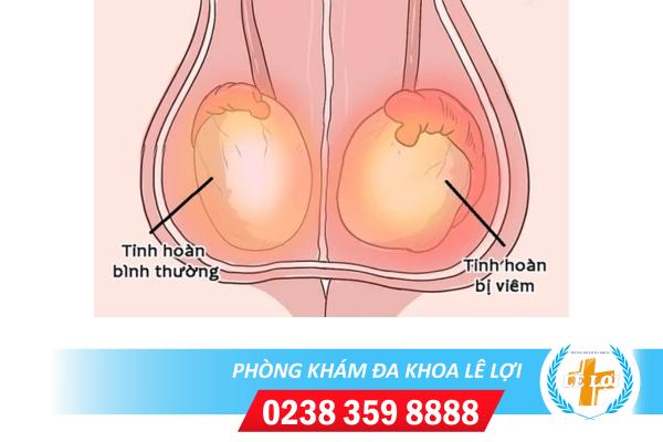 Các nguyên nhân gây viêm tinh hoàn ở nam giới là gì?