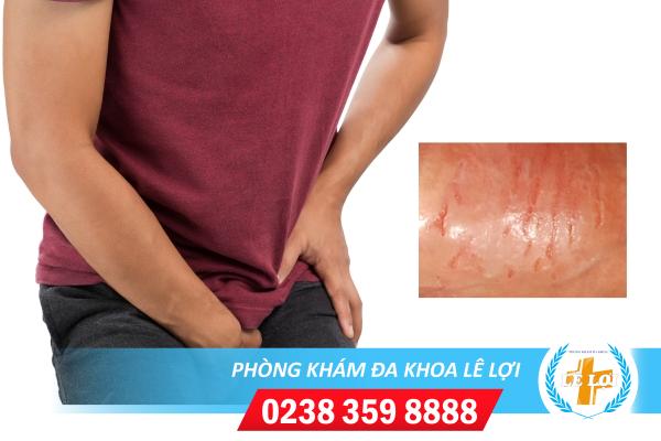 Nứt da quy đầu do đâu? Dấu hiệu và phương pháp hỗ trợ điều trị