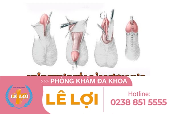 phau-thuat-keo-dai-duong-vat-the-nao