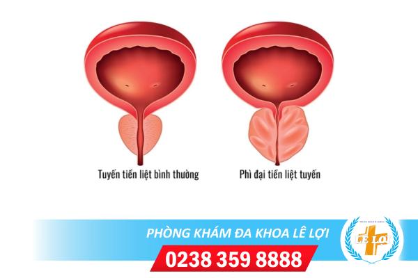 Cần cẩn thận với triệu chứng phì đại tuyến tiền liệt