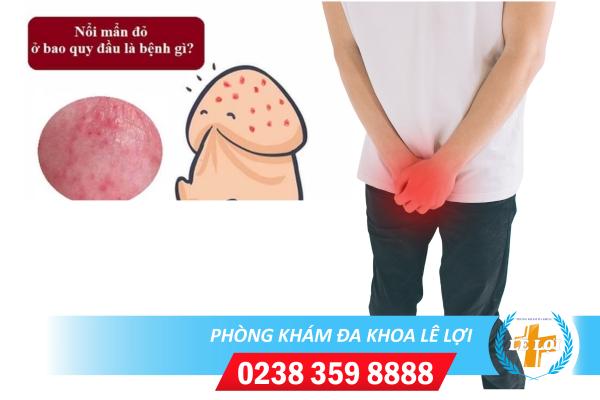 Quy đầu nổi mẩn đỏ dấu hiệu của nhiều bệnh nguy hiểm