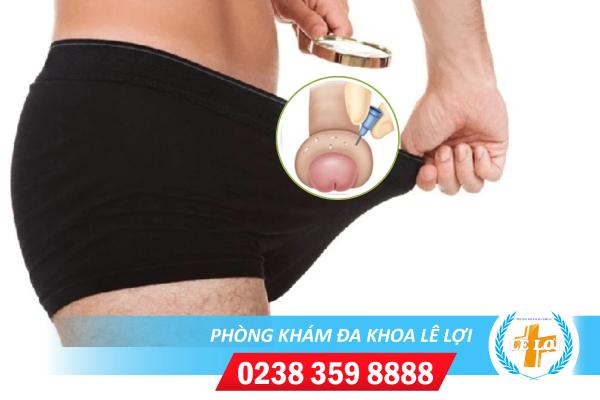 Sưng bao quy đầu là triệu chứng của bệnh gì?